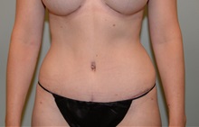 Tummy Tuck After Photo by Elisa Burgess, MD; Lake Oswego, OR - Case 32696