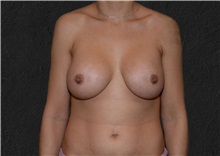Breast Augmentation After Photo by Elisa Burgess, MD; Lake Oswego, OR - Case 37493