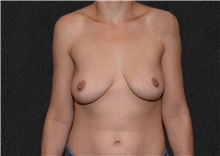Breast Augmentation Before Photo by Elisa Burgess, MD; Lake Oswego, OR - Case 37493