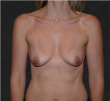 Breast Augmentation Before Photo by Elisa Burgess, MD; Lake Oswego, OR - Case 37495