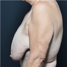Breast Reduction Before Photo by Elisa Burgess, MD; ,  - Case 50465