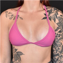Breast Augmentation After Photo by Elisa Burgess, MD; ,  - Case 50537