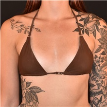 Breast Augmentation Before Photo by Elisa Burgess, MD; ,  - Case 50537