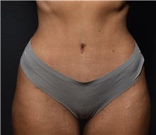 Tummy Tuck After Photo by Elisa Burgess, MD; ,  - Case 50539