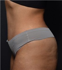 Tummy Tuck After Photo by Elisa Burgess, MD; ,  - Case 50539