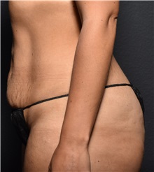 Tummy Tuck Before Photo by Elisa Burgess, MD; ,  - Case 50539