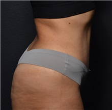 Tummy Tuck After Photo by Elisa Burgess, MD; ,  - Case 50539