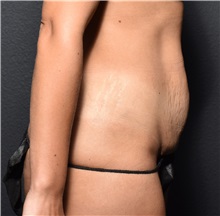 Tummy Tuck Before Photo by Elisa Burgess, MD; ,  - Case 50539