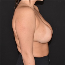 Breast Augmentation After Photo by Elisa Burgess, MD; ,  - Case 50572