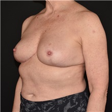 Breast Reduction After Photo by Elisa Burgess, MD; ,  - Case 50580