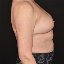 Breast Reduction After Photo by Elisa Burgess, MD; ,  - Case 50580