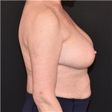 Breast Reduction Before Photo by Elisa Burgess, MD; ,  - Case 50580