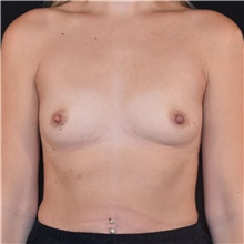 Breast Augmentation Before Photo by Elisa Burgess, MD; ,  - Case 50605
