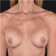 Breast Augmentation After Photo by Elisa Burgess, MD; ,  - Case 50620