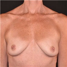 Breast Augmentation Before Photo by Elisa Burgess, MD; ,  - Case 50620