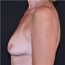 Breast Augmentation Before Photo by Elisa Burgess, MD; ,  - Case 50620