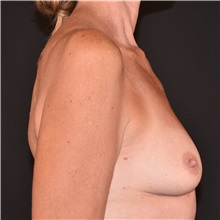 Breast Augmentation Before Photo by Elisa Burgess, MD; ,  - Case 50620