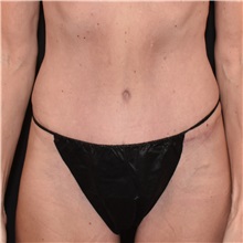 Tummy Tuck After Photo by Elisa Burgess, MD; ,  - Case 50619