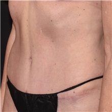 Tummy Tuck After Photo by Elisa Burgess, MD; ,  - Case 50619