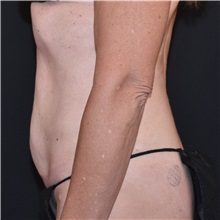 Tummy Tuck Before Photo by Elisa Burgess, MD; ,  - Case 50619
