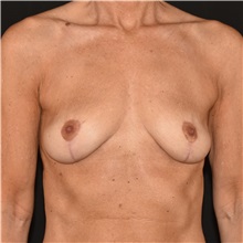 Breast Implant Removal After Photo by Elisa Burgess, MD; ,  - Case 50674