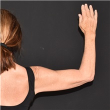 Arm Lift After Photo by Elisa Burgess, MD; ,  - Case 50704