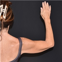 Arm Lift Before Photo by Elisa Burgess, MD; ,  - Case 50704