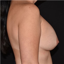 Breast Augmentation After Photo by Elisa Burgess, MD; ,  - Case 50769