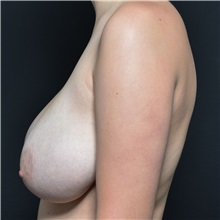 Breast Reduction Before Photo by Elisa Burgess, MD; ,  - Case 50819