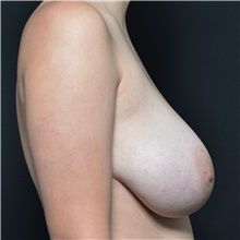 Breast Reduction Before Photo by Elisa Burgess, MD; ,  - Case 50819