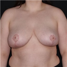 Breast Reduction After Photo by Elisa Burgess, MD; Lake Oswego, OR - Case 50829