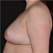 Breast Reduction After Photo by Elisa Burgess, MD; Lake Oswego, OR - Case 50829