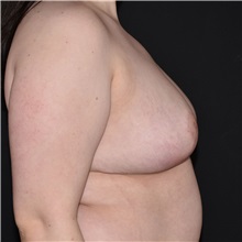 Breast Reduction After Photo by Elisa Burgess, MD; Lake Oswego, OR - Case 50829