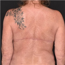 Body Lift After Photo by Elisa Burgess, MD; Lake Oswego, OR - Case 50843