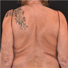 Body Lift Before Photo by Elisa Burgess, MD; Lake Oswego, OR - Case 50843