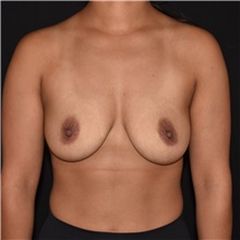 Breast Augmentation Before Photo by Elisa Burgess, MD; Lake Oswego, OR - Case 50844