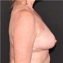 Breast Reduction After Photo by Elisa Burgess, MD; Lake Oswego, OR - Case 50842