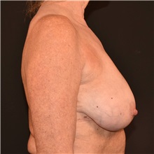 Breast Reduction Before Photo by Elisa Burgess, MD; Lake Oswego, OR - Case 50842