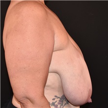 Breast Reduction Before Photo by Elisa Burgess, MD; Lake Oswego, OR - Case 50894