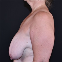 Breast Reduction Before Photo by Elisa Burgess, MD; Lake Oswego, OR - Case 50894