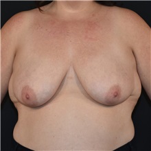 Breast Reconstruction Before Photo by Elisa Burgess, MD; Lake Oswego, OR - Case 50916