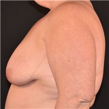 Breast Reconstruction Before Photo by Elisa Burgess, MD; Lake Oswego, OR - Case 50916