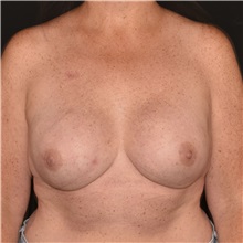 Breast Reconstruction After Photo by Elisa Burgess, MD; Lake Oswego, OR - Case 50914