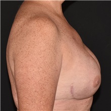 Breast Reconstruction After Photo by Elisa Burgess, MD; Lake Oswego, OR - Case 50914