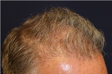 Hair Transplant After Photo by Richard Chaffoo, MD; La Jolla, CA - Case 35349