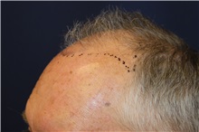 Hair Transplant Before Photo by Richard Chaffoo, MD; La Jolla, CA - Case 35349
