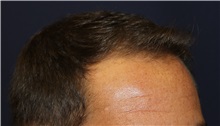 Hair Transplant Before Photo by Richard Chaffoo, MD; La Jolla, CA - Case 35350