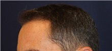 Hair Transplant Before Photo by Richard Chaffoo, MD; La Jolla, CA - Case 35350