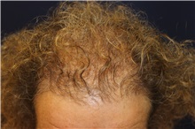 Hair Transplant After Photo by Richard Chaffoo, MD; La Jolla, CA - Case 35353