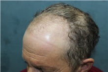 Hair Transplant Before Photo by Richard Chaffoo, MD; La Jolla, CA - Case 35353
